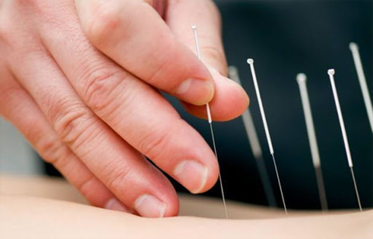Kỹ thuật Hào châm theo y học cổ truyền